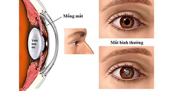 Đục thủy tinh thể: Nhận biết, nguyên nhân, điều trị, phòng ngừa